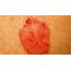 HEALTH FROM TRUSTED SOURCES Squamous Cell Carcinoma Of The Skin