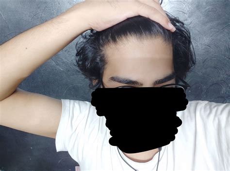 Is this hairline normal for a 20 year old? I have thinning around the crown region. : Hairloss