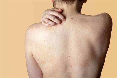 Toronto public health staff cannot book vaccine. There's a New Way to Treat Body Acne - Toronto Dermatology ...