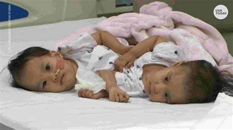 Conjoined Twin Girls Successfully Separated After Six Hour Surgery