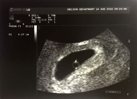 What's the bleeding story? | Hope After Miscarriage