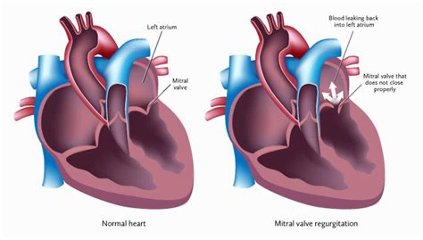 Mitral Valve Regurgitation Cardiovascular Institute Of The Shoals