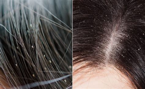 Head Lice Vs Dandruff Identifying What You Have