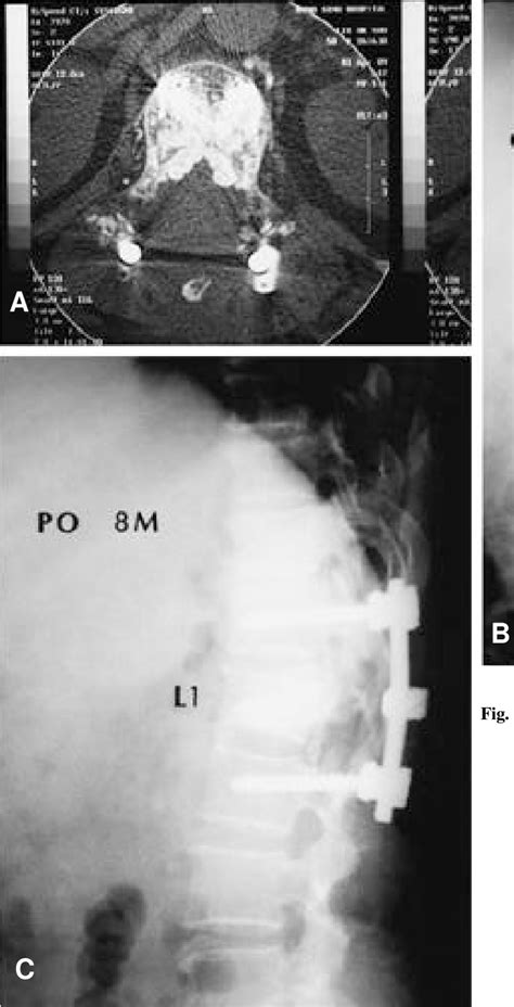 Figure From Surgical Treatment Of Root Injury After Percutaneous