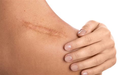 How To Reduce Scar Tissue After Surgery Best Practices And Treatments