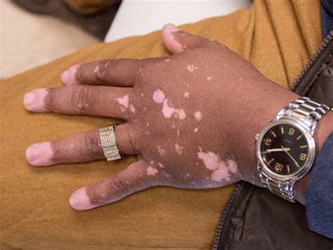 Vitiligo Treatments Help Patients Get Through Rough Patch University