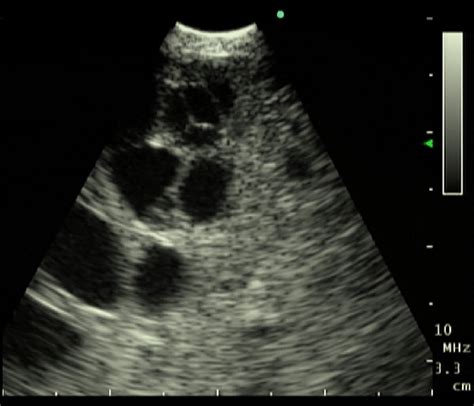 Endobronchial Ultrasound Ebus Revealed A Large Heterogeneous Cystic
