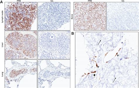 a paracrine role for il6 in prostate cancer patients lack of production by primary or