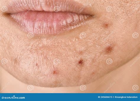 Facial Skin Problem Acne Disease In Adult Close Up Woman Face With