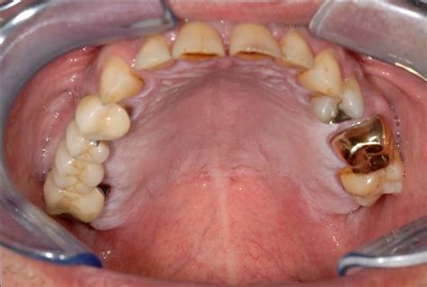 This alteration is withish,diffuse and opalescent, usually bilateral leukoedema has a definite predilection in black americans, but there is a controversie abuot the. World "Oral Cancer Treatment Market" Ultimate Analysis by ...