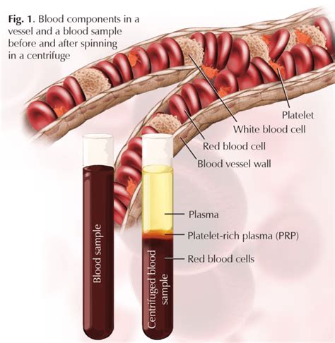 Platelet Rich Plasma Therapy Wellness At Hughston Clinic Tennessee
