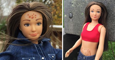 Normal Barbie Has Realistic 19 Year Old Body Shape With Acne Bruises