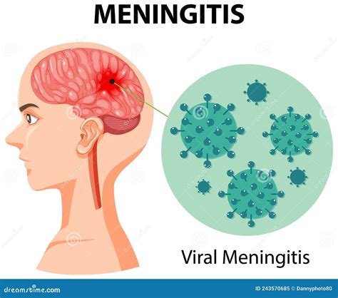 Diagram Showing Meningitis In Human Brain Stock Vector Illustration