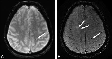 Improved Mr Imaging Detection Of Cerebral Microbleeds More Accurately