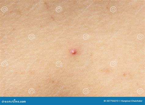 Photo Of Nodular Cystic Acne Skin Chronic Acne Skin On Woman Surface