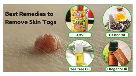 best ways that work well for removing skin tags