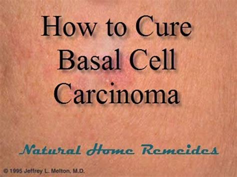 How To Cure Basal Cell Carcinoma Youtube