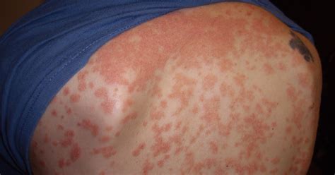 Psoriasis Pictures Identifying Your Rash Universal Body Health