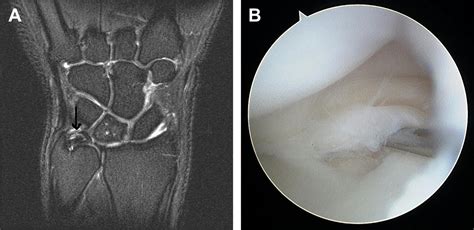 Arthroscopic And Open Repair Of The TFCC Hand Clinics