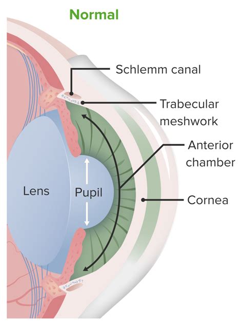 Glaucoma Concise Medical Knowledge