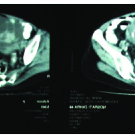 pelvic ct scan of the patient showing the mass in the pelvic cavity download scientific diagram