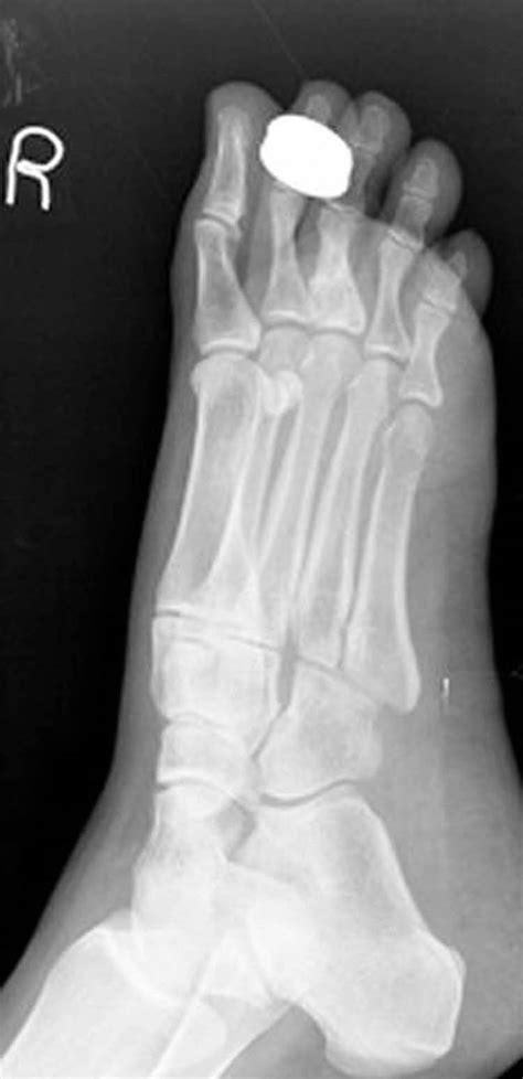 Lytic Lesion Toe The Foot And Ankle Online Journal