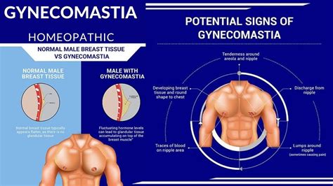 Gynecomastia Enlarged Male Breast Lump Tissue Symptoms Causes