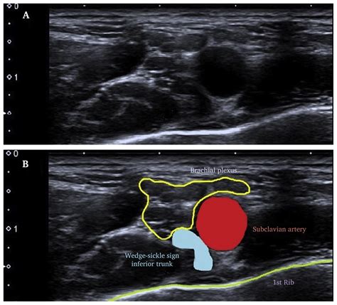 Value Of Ultrasound In The Diagnosis Of Neurogenic Thoracic Outlet