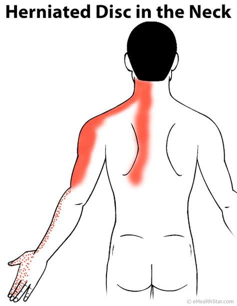 11 Pinched Nerve In Neck Ideas Pinched Nerve Pinched Nerve In Neck