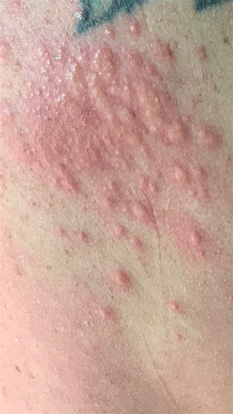Itchy Skin Rash On Back