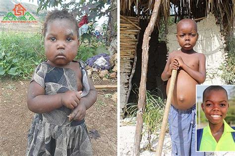 bệnh kwashiorkor nguyên nhân và cách phòng ngừa thế nào