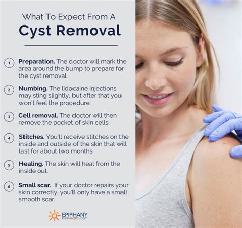 What To Expect From Cyst Removal Epiphany Dermatology