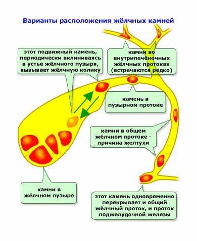 Вырезанный желчный пузырь диета Желчный Пузырь Камни Симптомы И Лечение Диета — Похудение Диета Желчный Пузырь Камни Симптомы И Лечение Диета — Похудение Диета Вырезанный желчный пузырь диета