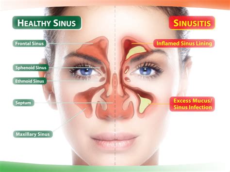 Cleaned Sinuses In 30 Seconds Home Remedies For Sinus Sinus