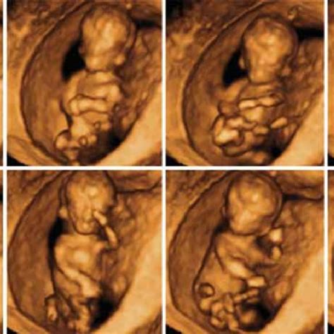 4d Us Imaging Demonstrated Fetus At 13 Weeks Of Gestation Showing