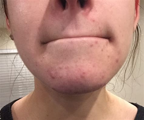 Cystic Acne On Chin What Is It And Pictures All About Cystic Acne