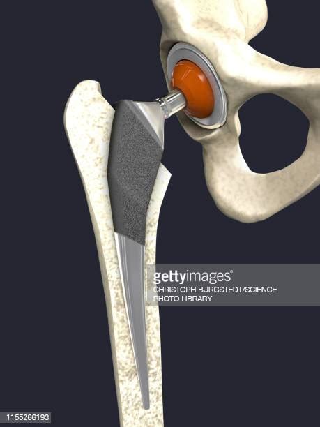 Artificial Hip Joint Photos And Premium High Res Pictures Getty Images