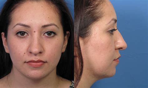 Hispanic Rhinoplasty Surgery Cosmetic Ethnic Nose Reshaping Dr Hilinski