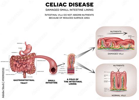 Gastrointestinal Tract Anatomy And Celiac Disease Affected Small