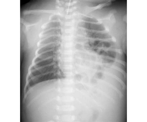 Chest Radiograph In Case 2 Chest Radiograph Shows Left Diaphragmatic