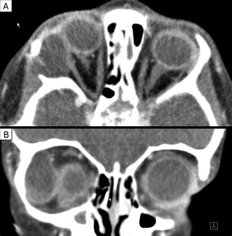 Dermoid Cysts Clinical Predictors Of Complex Lesions And Surgical