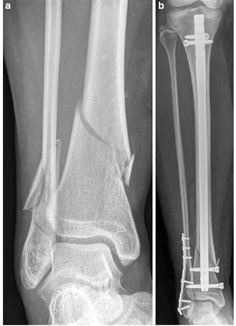 Distal Tibial Fractures Intramedullary Nailing PDF Download Available