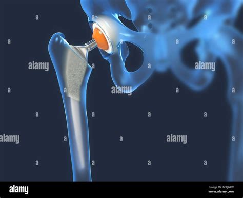 Hip Replacement Illustration Stock Photo Alamy