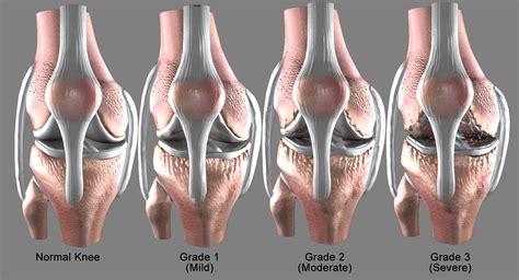 Osteoarthritis Severe Condition Knee D Model TurboSquid