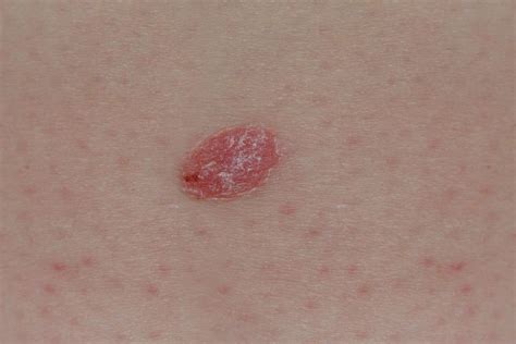 Skin Cancer Images Early Stages Fogueira Molhada