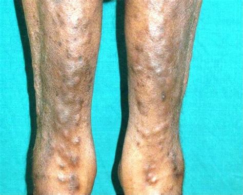 Multiple Painful Nodules What Is The Diagnosis