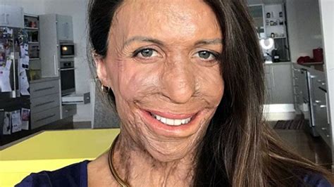 Turia Pitt Ironman Photo Is A Reminder Of Her Incredible Resilience Honey