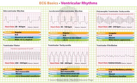 Ecg Diagram And Meanings Of Rhythm