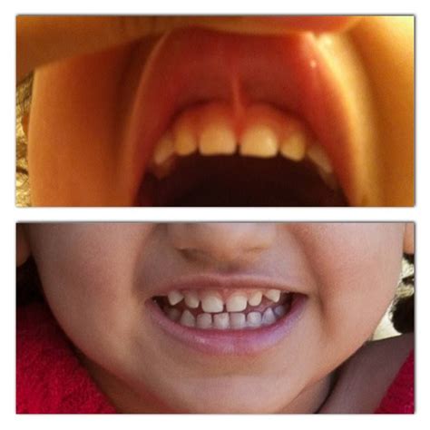 Discovering And Correcting Lip Tie On A Toddler And An Infant Tongue