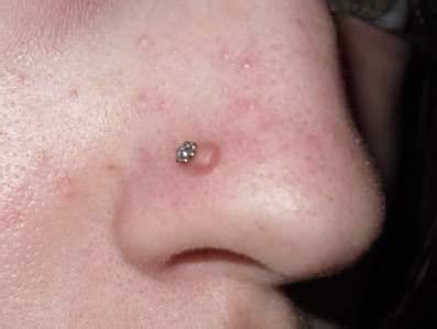 Nose Piercing Bumps Are Very Common But Also Extremely Unsightly We